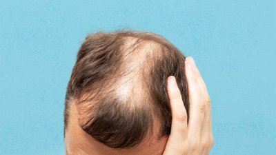 androgenic-alopecia-causes-and-risk-factors-subguide-1440x810.jpg