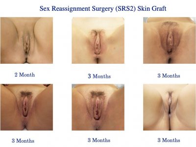 Sex-Reassignment-Surgery-SRS2-Skin-Graft-1.jpg