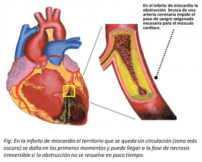 infarto-de-miocardio-1024x821.jpg