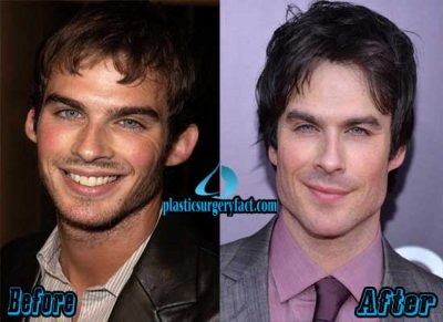 Ian-Somerhalder-Plastic-Surgery-Before-and-After.jpg