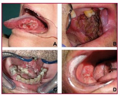 ug%C3%ADa-maxilofacial_-Dr.-Bucci_c%C3%A1ncer-oral.jpg